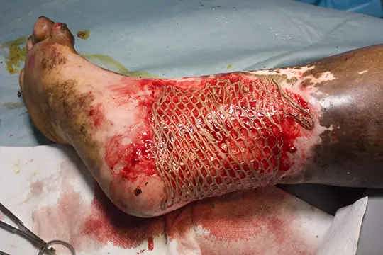 Foot Burn Injury