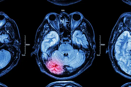 Brain scan image